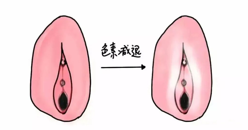 女孩子外阴部位出现外阴营养不良是怎么回事？