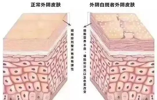 自行使用激素药膏到底能不能治好外阴白斑呢？