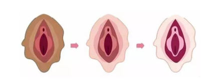 外阴白斑会传染吗？